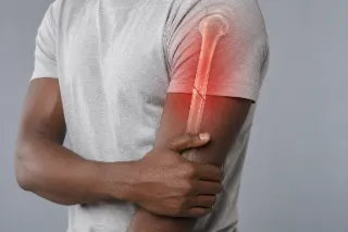 Humerus Bone Fracture Showing Upper Arm Injury Medical Illustration