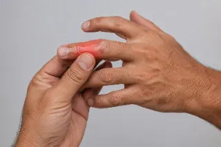 Finger Fracture And Joint Inflammation Closeup - Medical Stock Photo