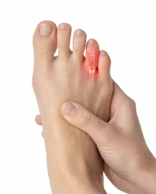 Toe Fracture and Joint Pain in Foot - Orthopedic Medical Photo