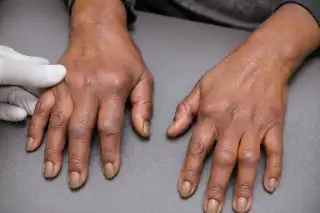 Rheumatoid Arthritis Hands Showing Joint Deformity and Swelling - Clinical Stock Photo
