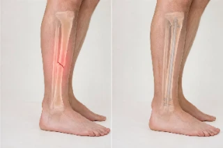 Tibial Shaft Fracture and Intramedullary Nail Fixation Comparison