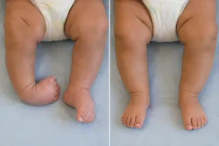 Clubfoot Correction Results in Infant Feet Before and After Treatment