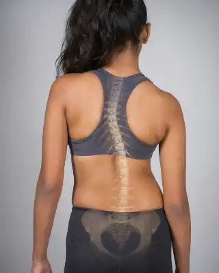 Anatomical Overlay Showing Scoliosis Spine Curvature in Young Female