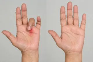 Trigger Finger Before and After Treatment Comparison