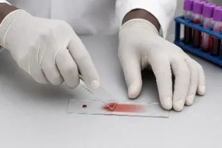Laboratory Technician Preparing Blood Smear on Glass Slide - Clinical Pathology Photo